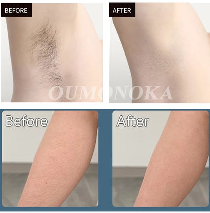 999,999 Flashes IPL Laser Epilator for Painless Home Hair Removal